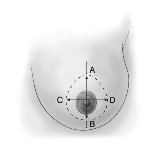 Cicatriz Periareolar