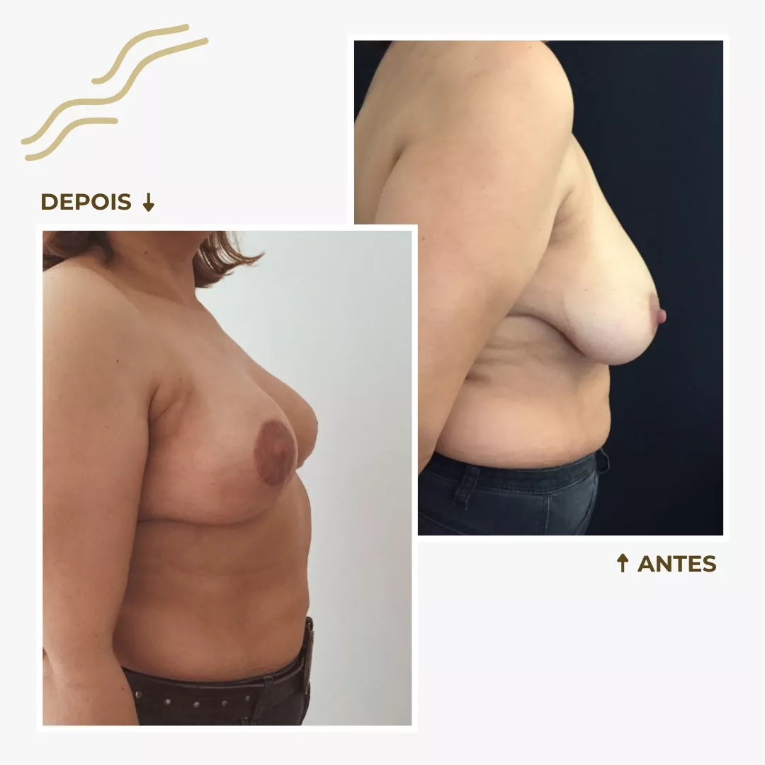 Redução Mamária