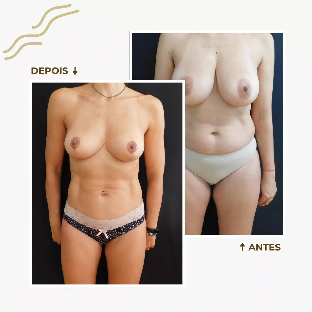 Caso de lipoescultura antes e depois