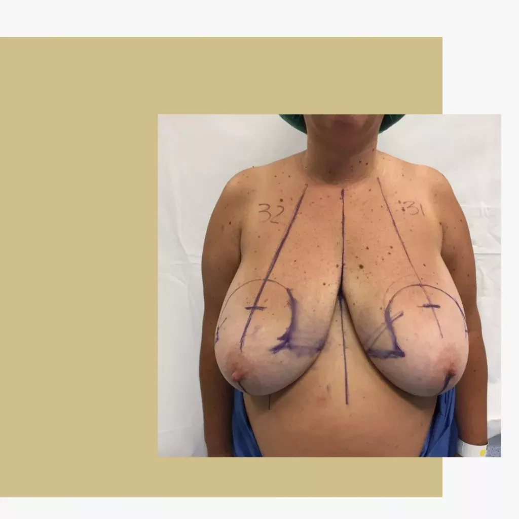 Mamoplastia Redutora