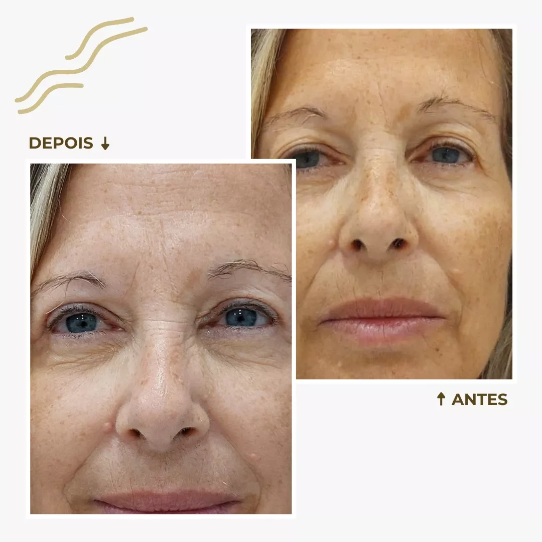 Blefaroplastia