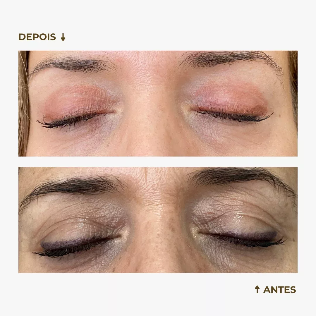 Casos antes e depois blefaroplastia (3)