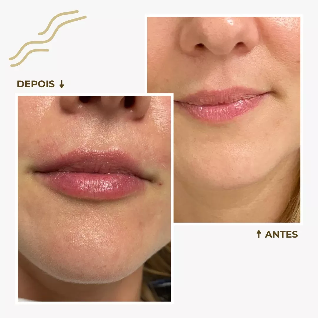 Antes e depois de um Preenchimento Labial