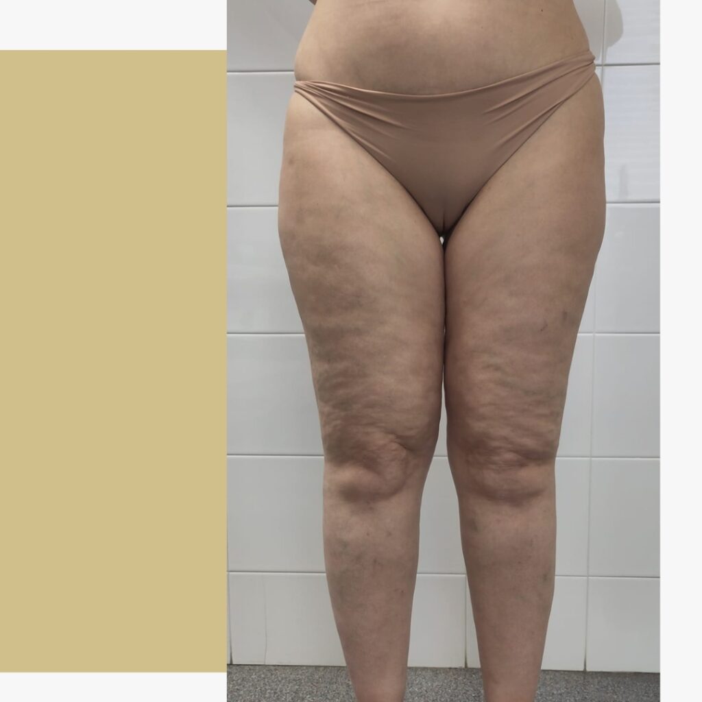 O que é o Lipedema