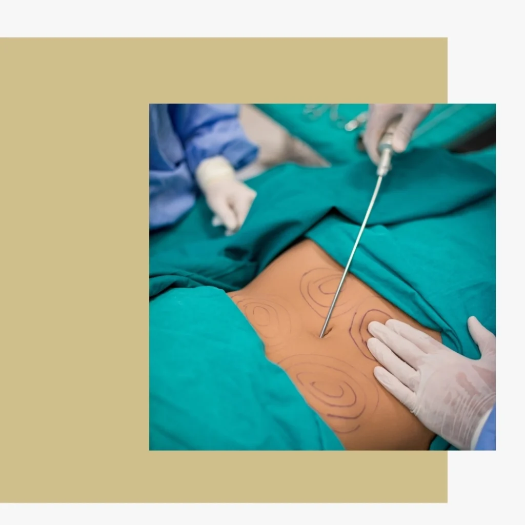 O que é a Lipoabdominoplastia