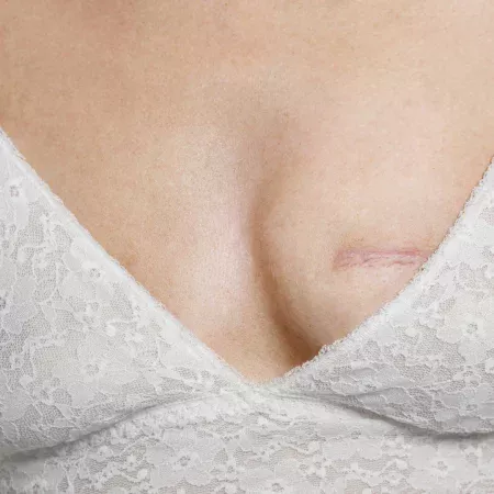 Reconstrução Mamária