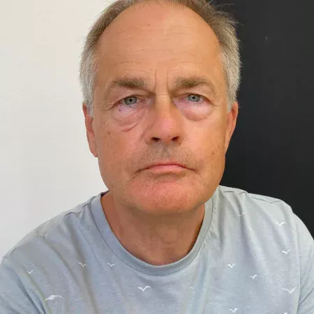 Tratamento Olheiras Clinica Ana Silva Guerra