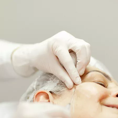 Tratamento de Medicina Estética com Bioestimuladores