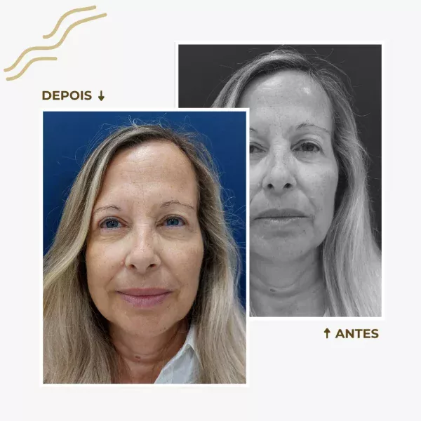 antes e depois blefaroplastia - 2