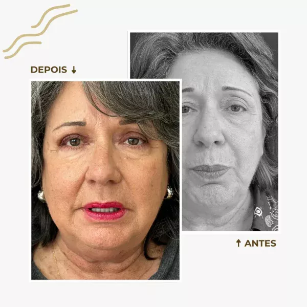 Antes e depois blefaroplastia