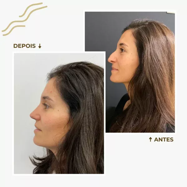 antes e depois rinoplastia