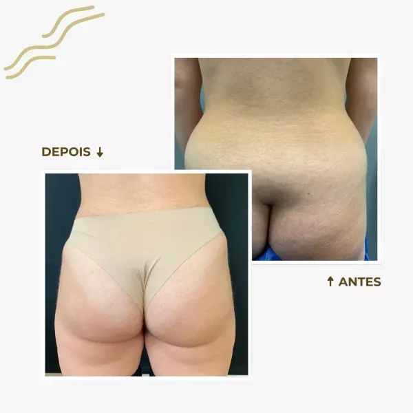 Antes e depois de uma Lipoaspiração