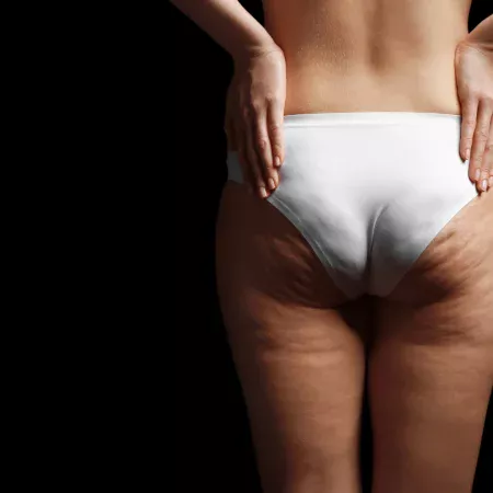 Lipedema Lipedema