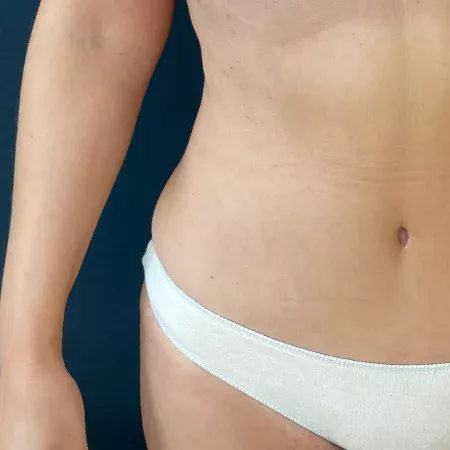 Lipoaspiração ou Lipoplastia