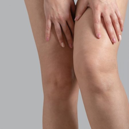 Sintomas do Lipedema Sintomas do Lipedema